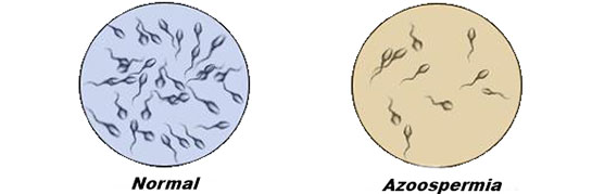 Azoospermia Özellikleri ve Faydaları Nelerdir?