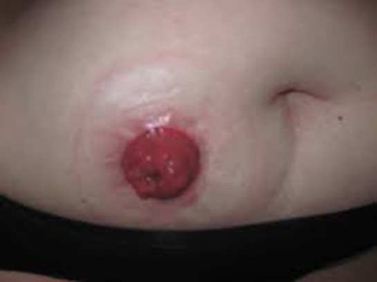 Stoma Özellikleri ve Faydaları Nelerdir?